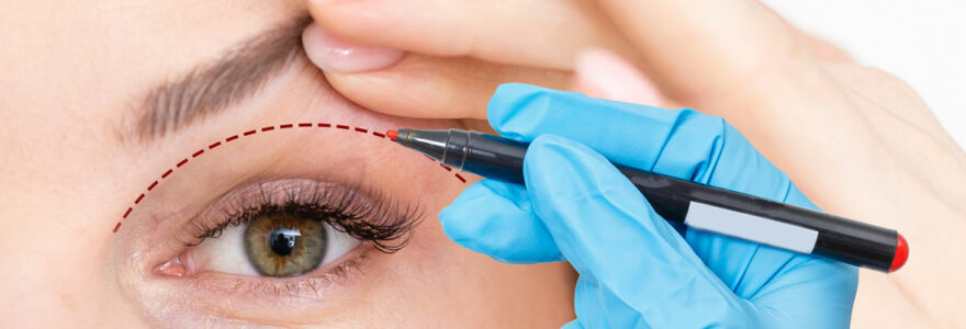 blépharoplastie