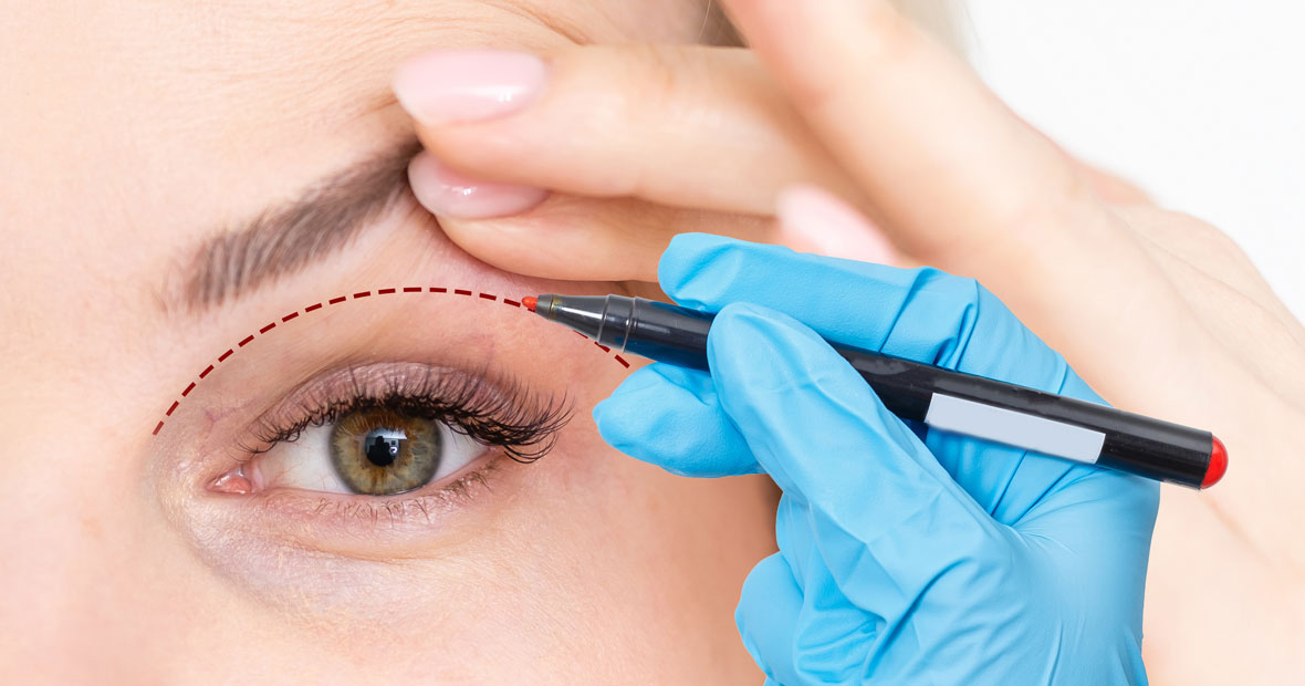 blépharoplastie